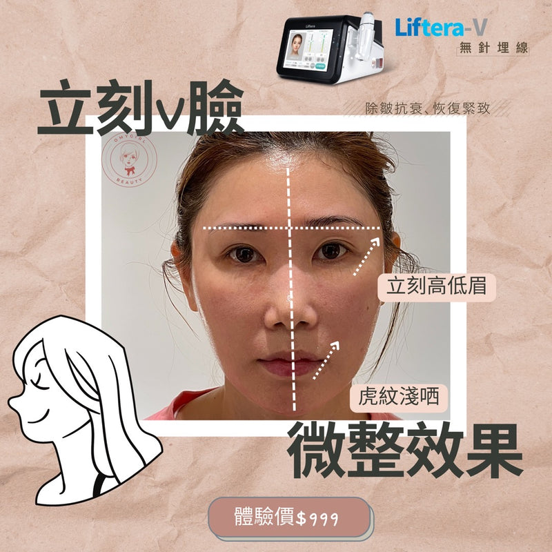 第4代「Liftera V Lift 無針埋線療程」